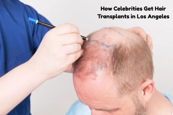 How Celebrities Get Hair Transplants in Los Angeles