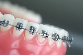 Orthodontics Market Forecast and Competitive Strategies 2025-2033