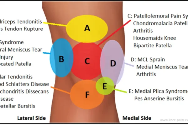 Why Is The Knee Pain Location Chart So Important?