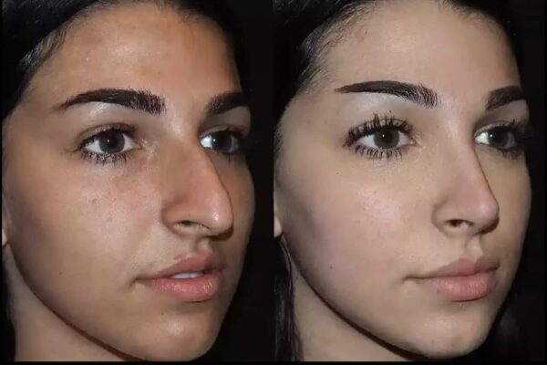 How the Best Doctors in Dubai Handle Complex Septoplasty Cases