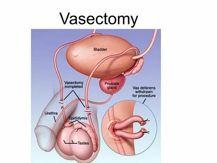 Vasectomy and Chronic Pelvic Pain Syndrome