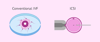 Test Tube Baby Center in Delhi – PCOS IVF Treatment