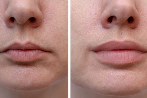 Lip Fillers Before and After – What You Need to Know
