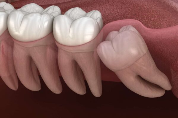 affordable wisdom tooth extraction singapore